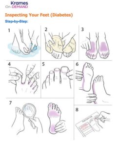 Foot Exam Graphic for Diabetes